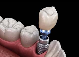 Dental implant in Grand Prairie