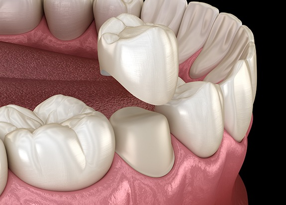 Animated dental crown placement