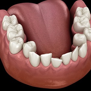 Illustration of crooked teeth