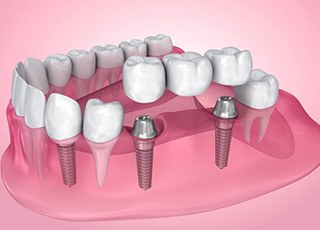 Illustration of dental implants with bridge