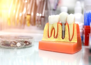 Model of dental implant in Grand Prairie, TX on dentist’s table