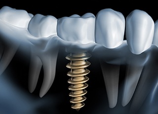 Model of dental implant in Grand Prairie, TX among natural teeth