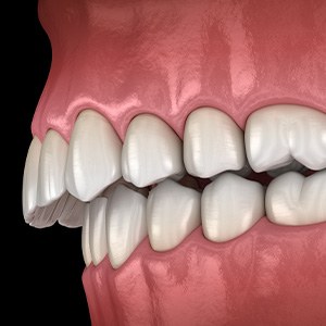 Illustration of an overbite