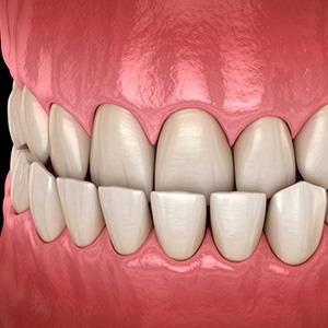 Illustration of an underbite