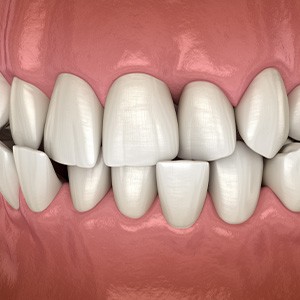 Illustration of a crossbite