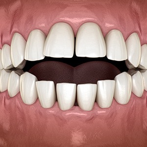 Illustration of an open bite