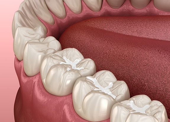 Animated row of teeth with metal free dental restorations