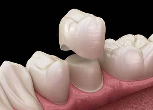 a 3D illustration of a dental crown