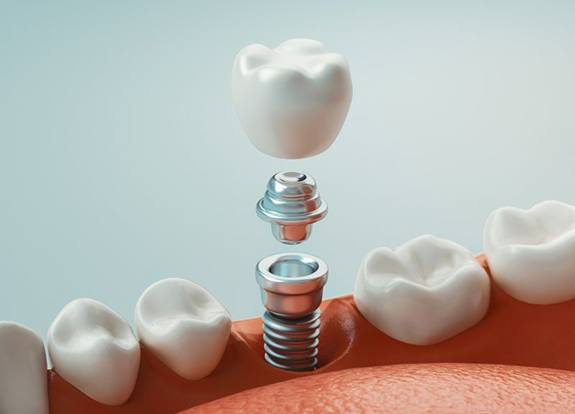 Diagram of a dental implant in Grand Prairie