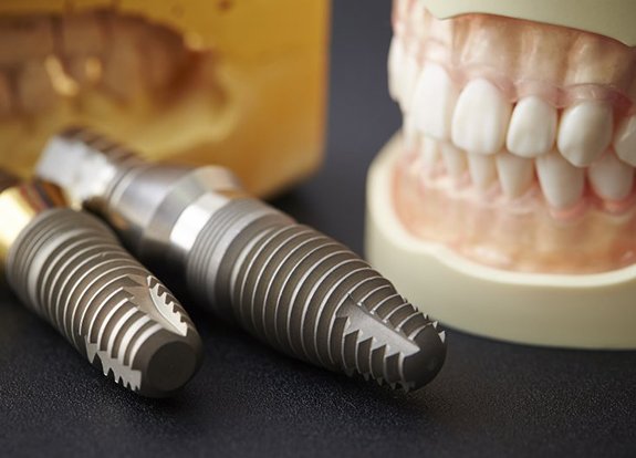 Dental implants in Grand Prairie next to model of teeth