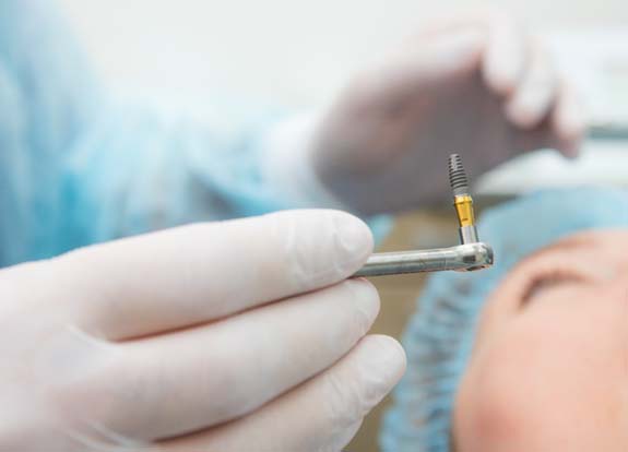 Dental specialist preparing to place implant in patient’s mouth