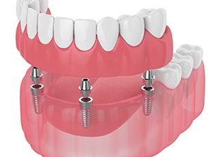 Diagram of implant dentures in Grand Prairie on white background