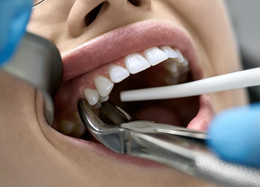 Patient in Grand Prairie getting a tooth extraction