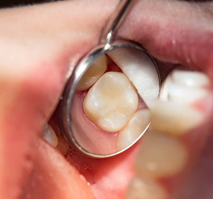 A tooth with a composite resin filling