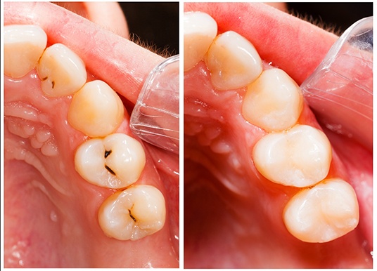 Teeth before and after composite resin fillings