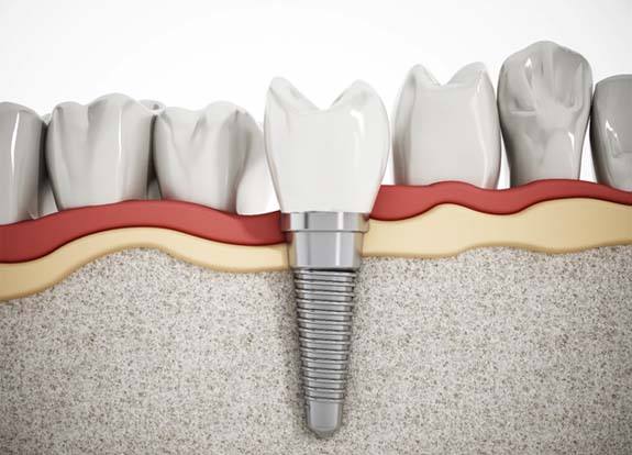 Illustration of dental implant and restoration between natural teeth