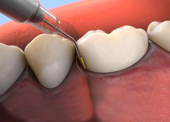 Animated antibiotic therapy treatment