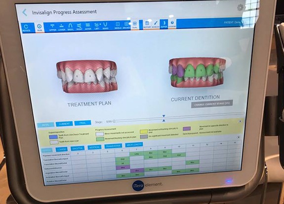 3 D iTero smile scans on computer screen