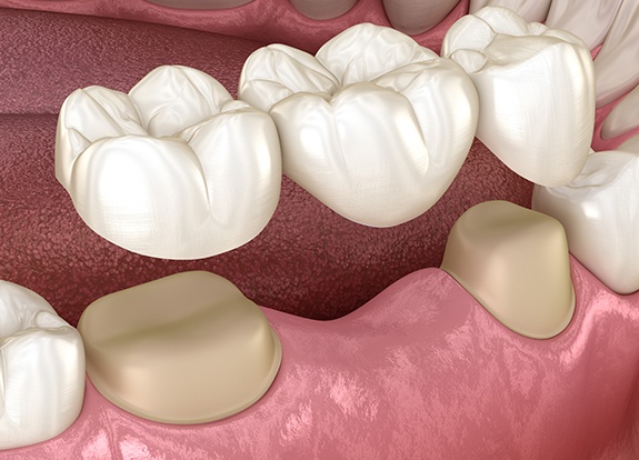 Animated dental bridge placement