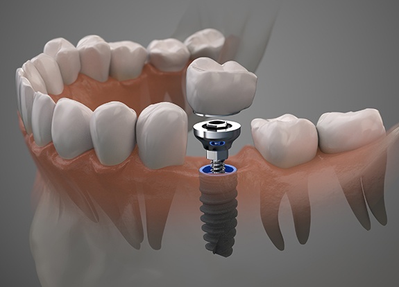 Aniamted dental implant placement