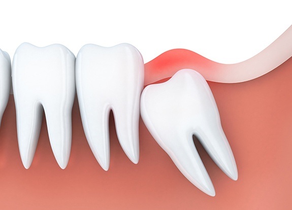 Animated smile with impacted wisdom tooth