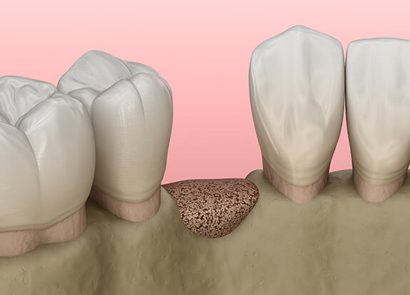 Animated smile with socket preservation bone graft