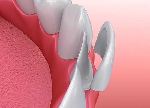 Closeup illustration of porcelain veneer placement in Grand Prairie