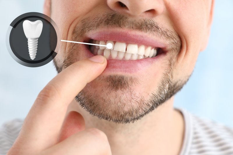 man smiling with dental implants