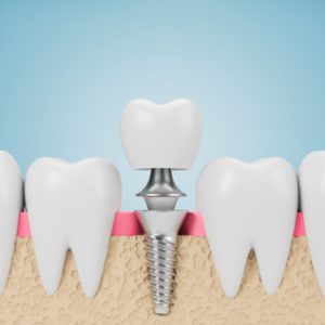 dental implant 3D illustration