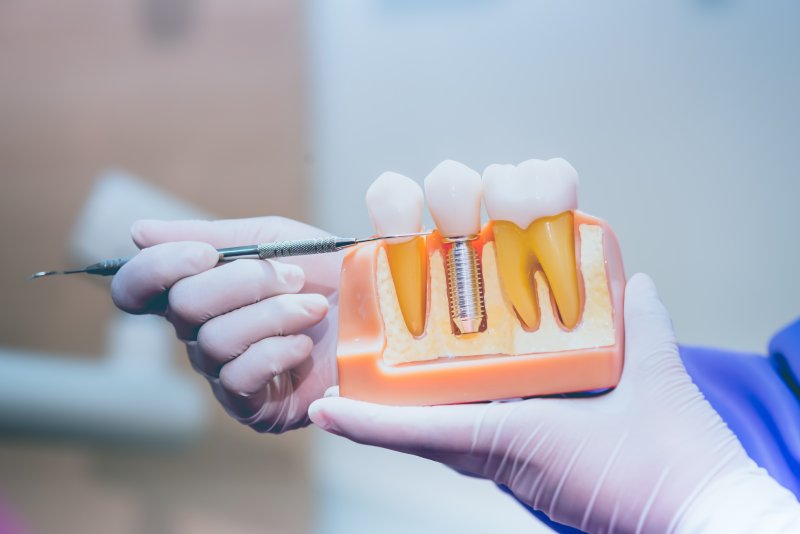 Plastic model of a dental implant