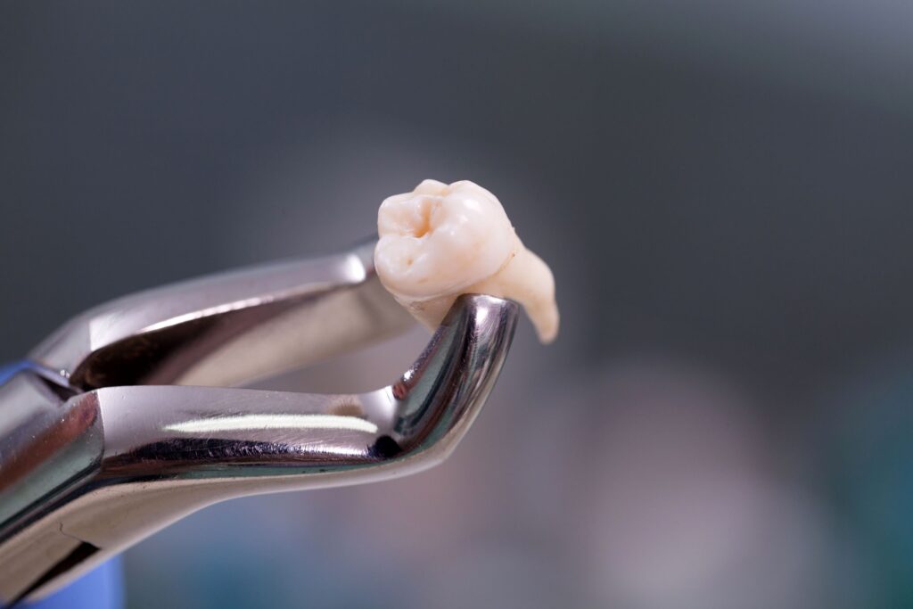 Closeup of silver forceps grasping extracted tooth