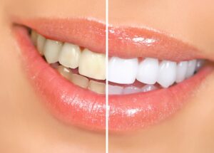 Before and after teeth whitening pictures compared. 