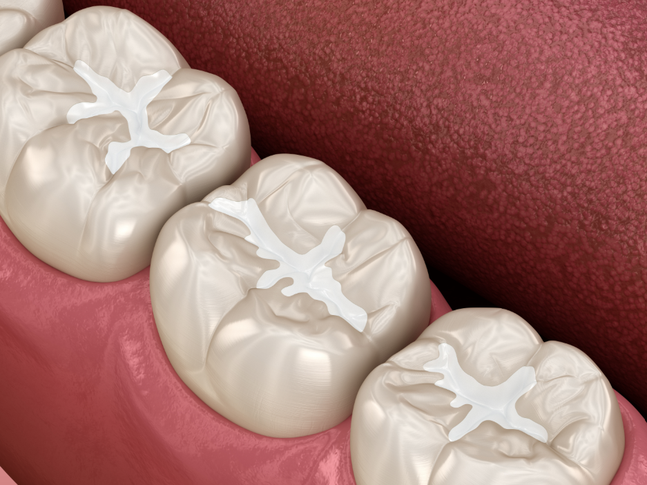 3D image of tooth-colored cavity filling